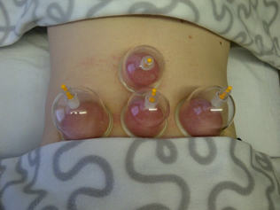 cupping Norwich